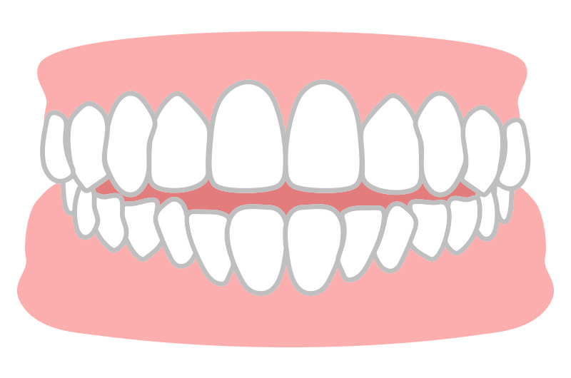 開咬（オープンバイト）