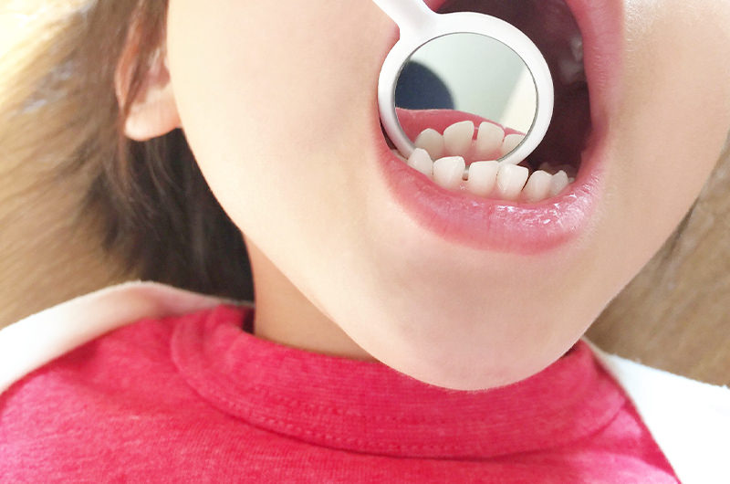 不正咬合とはどんな状態？