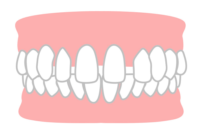 すきっ歯（空隙歯列）