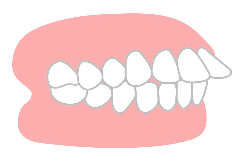 出っ歯（上顎前突）