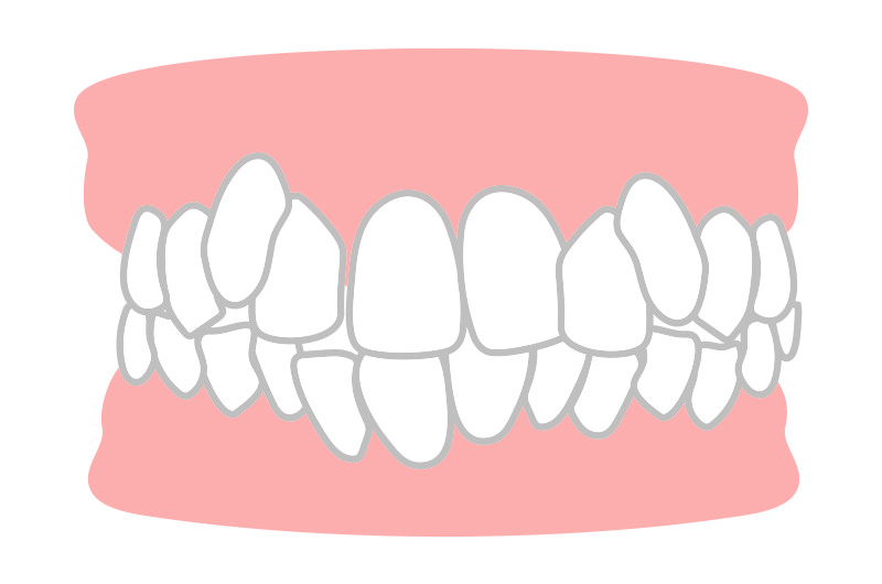 八重歯・叢生（そうせい）